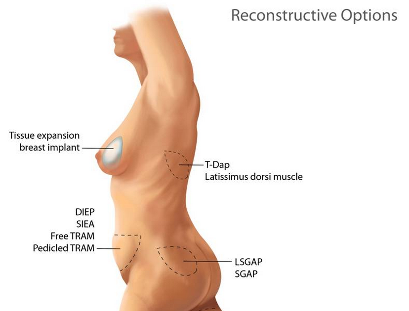 Breast reconstruction with latissimus dorsi and implant insertion