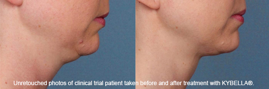 Learn about KYBELLA in Torrance