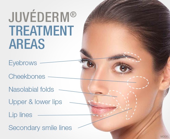 JUVÉDERM Treatment Areas