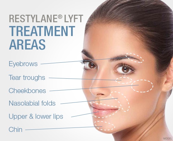Restylane Lyft Treatment Areas