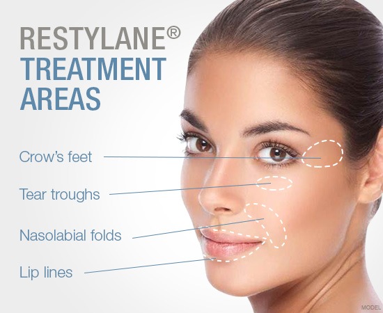 Restylane Treatment Areas