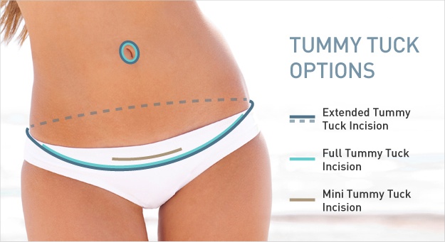 Tummy Tuck Incisions