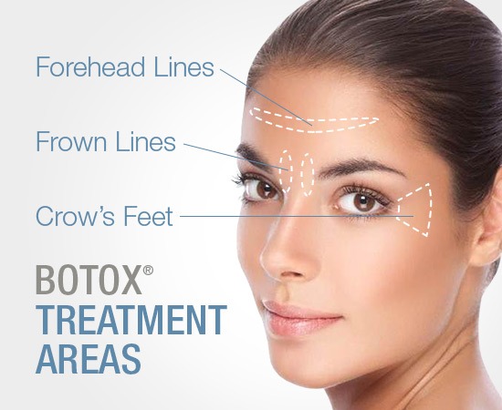 Botox Treatment Areas