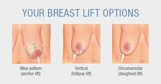 Different Breast Lift Options