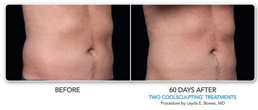 CoolSculpting Before and after photos