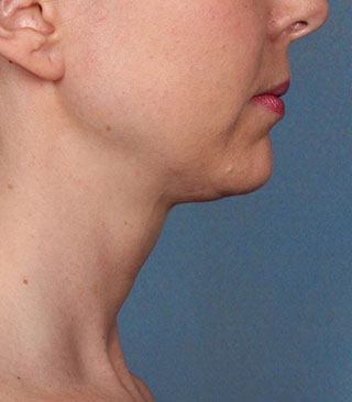 After Kybella Treatment