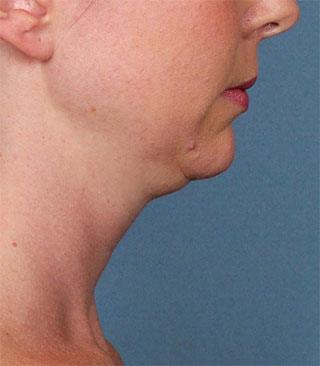 Before Kybella Treatment