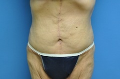 After Tummy Tuck Procedure