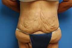 Before Tummy Tuck Procedure