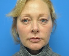 After Sculptra Treatment