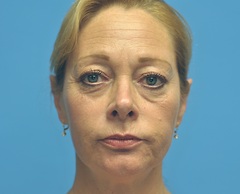 Before Sculptra Treatment