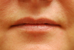 Before Restylane Treatment