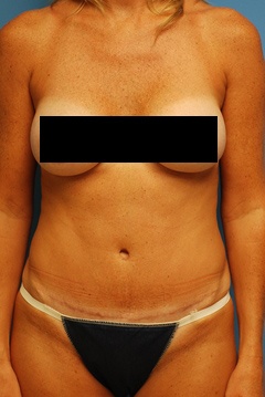 After Tummy Tuck Procedure