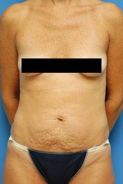 Before Tummy Tuck Procedure