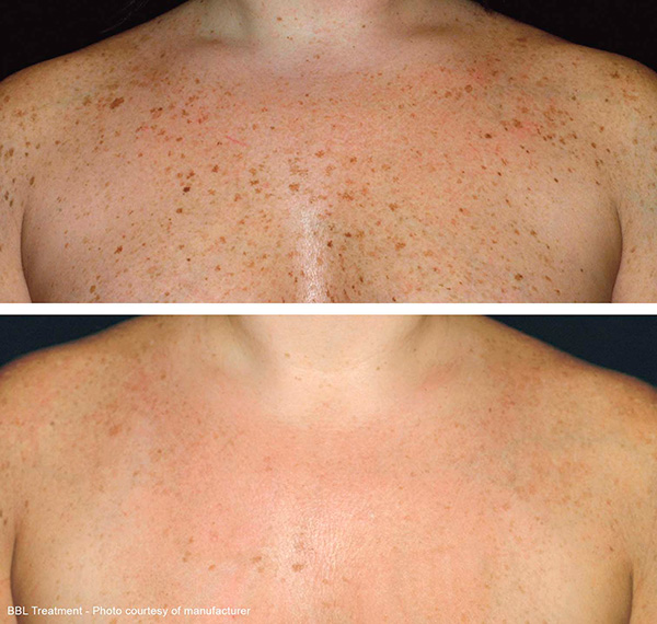 BBL Before And After