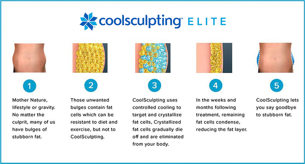 Diagram of the CoolSculpting Elite process