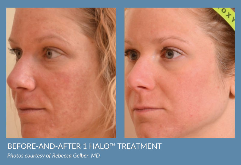 Before-and-after 1 Halo™ treatment