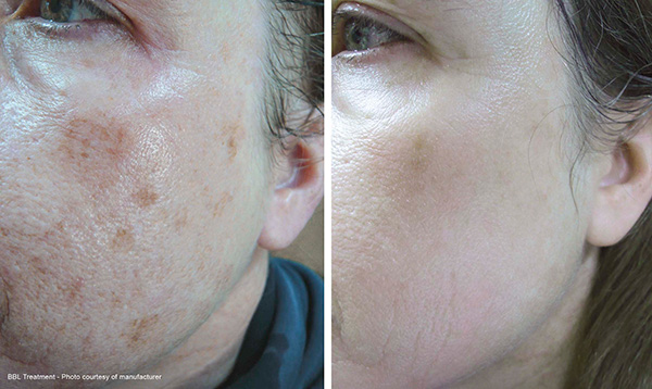 Before and After BBL treatment photos by Manufacturer.®