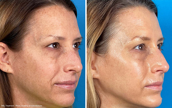 Before and After BBL treatment photos by Manufacturer.®