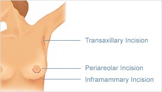 Incision location