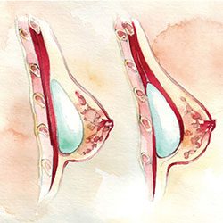implants over or under muscle