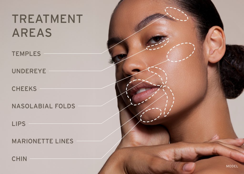Restylane treatment areas diagram