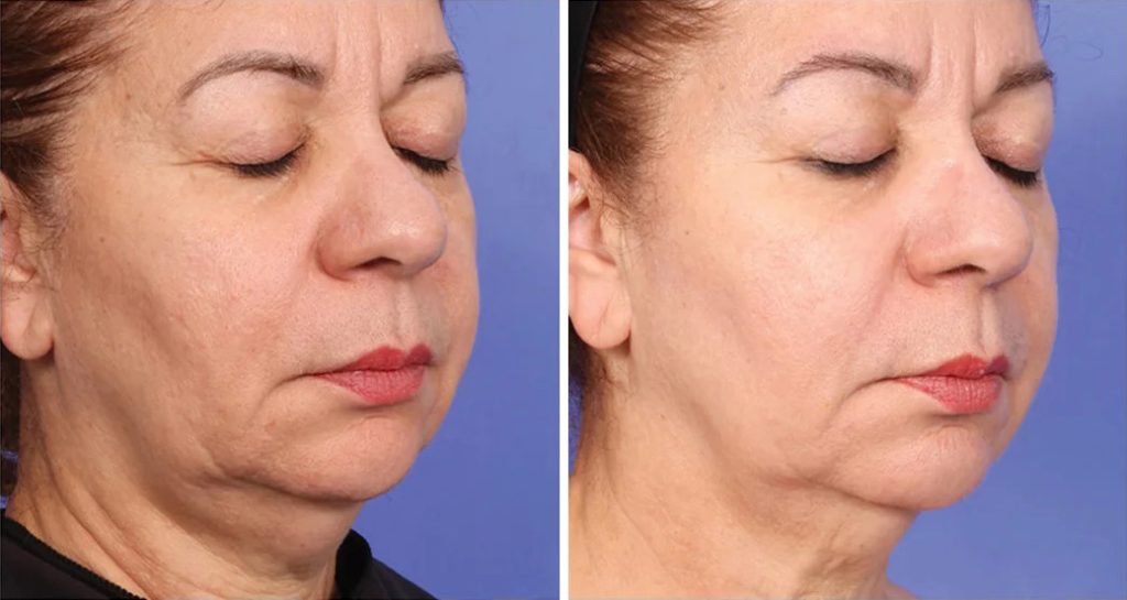 Before-and-after close-up photos of a woman with eyes closed, showing firmer skin and reduced jowls after one XERF treatment, against a blue background.