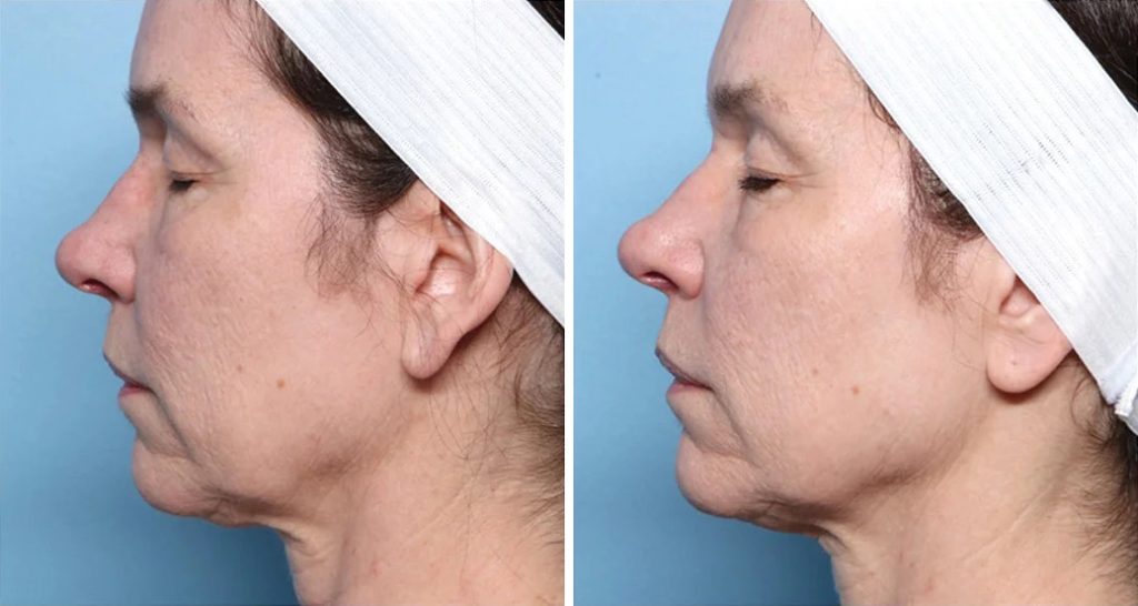 Side-by-side before-and-after profile photos of a middle-aged woman wearing a white headband, showing smoother skin and tighter jawline after two XERF treatments, against a blue background.