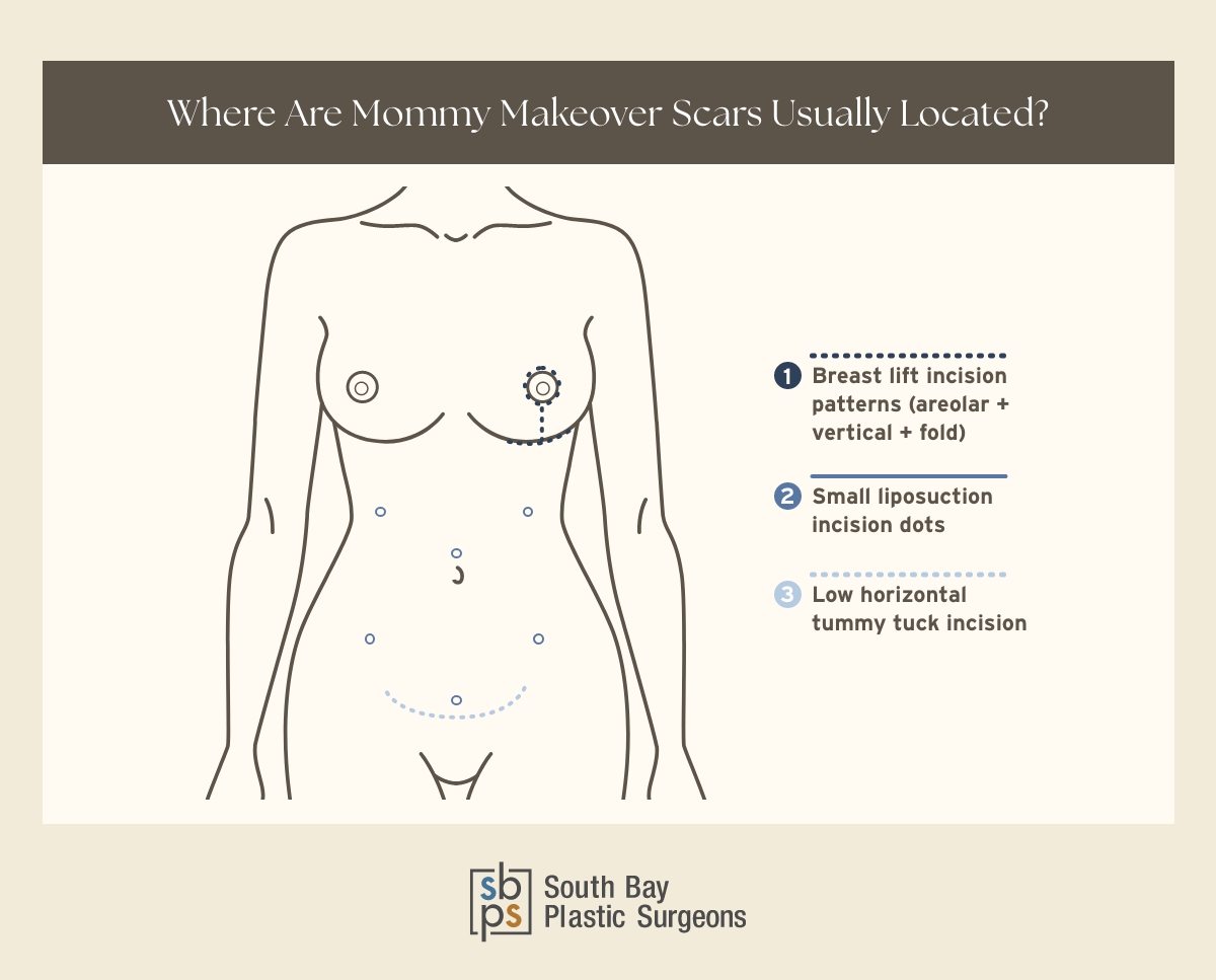 Visual guide to where are mommy makeover scars usually located.