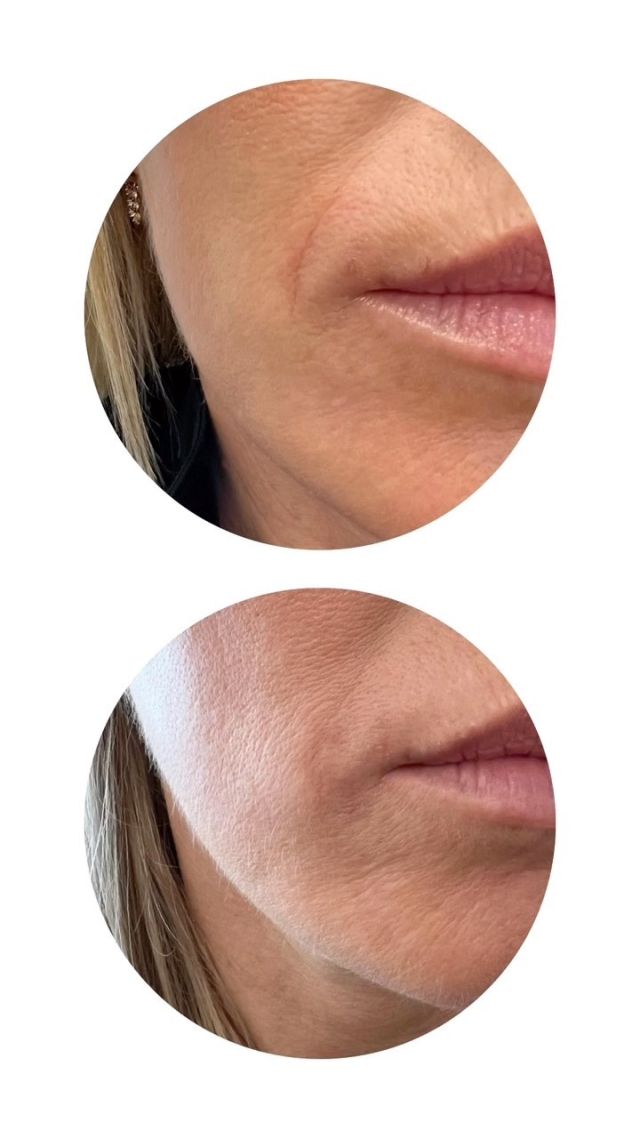 RHA Redensity represents the latest advancements in non-invasive facial rejuvenation. Redensity is the first and only HA filler approved by the FDA for superficial and dermal injections designed for the treatment of moderate to severe perioral wrinkles. ⁠
⁠
Perioral wrinkles are age-related facial wrinkles caused by the progressive loss of elasticity in the skin around the mouth. This coupled with the constant movement of your facial muscles will naturally cause even minor lip lines to get deeper and more pronounced as you age. ⁠
⁠
RHA Redensity features an innovative hyaluronic acid formula that adds natural looking volume back into the dermal tissue of your skin for a rejuvenated, youthful appearance. This is the first injectable formulated for use in both the higher surface layers and deeper dermal layers of the perioral area of the face.⁠
⁠
RHA Redensity is an anti-aging injectable that features the collection’s most gentle formula, allowing it to correct lip lines with natural-looking and long-lasting results.⁠
⁠
#RHA #RHAfiller #redensity #RHAredensity #filler #southbayplasticsurgeons #sbps #spaatsouthbayplasticsurgeons #southbay #medspa #southbay #aging #antiaging #glow