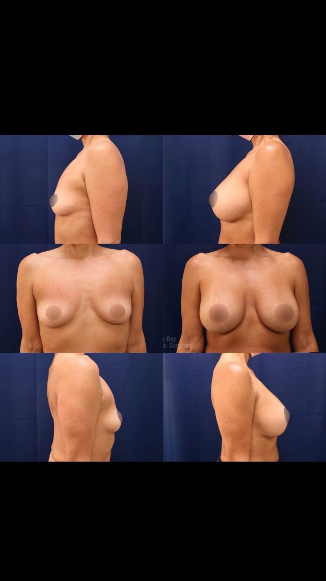 This 51-year-old woman wanted a fuller and more round breast shape. After consulting with one of our board certified plastic surgeons, she had a breast augmentation with Allergan 415cc high profile silicone implants @natrellebreastaugmentation 
The implants were placed under the muscle and through the inframammary (IMF/under the breast) incision. 

This patient loves her results!

Unedited photos at the link in bio. All photos posted with patient permission.

Click the link in our bio or call us at 310-784-0644 to schedule a consultation!

#naturalresults #freethenipple #siliconeimplants #breastimplants #breastenhancement #breastaugmentation #cosmeticsurgery #plasticsurgery #losangelesplasticsurgeon #southbay #southbayplasticsurgeons #sientra #sientraimplants #sbps #plasticsurgeon
