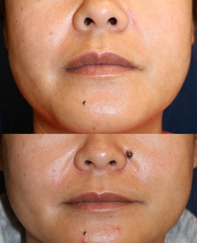 This 37-year old woman was unhappy with the mole on the left side of her face. Our board-certified plastic surgeon removed it in our procedure room while the patient was awake.⁠
⁠
A common concern among patients is having a noticeable scar after a procedure. While there will always be a scar when the skin is cut, we do everything we can to minimize the appearance through technique and aftercare.⁠
⁠
Do you have a mole that you would like removed? Click the link in our bio or call us at 310-784-0644 to schedule today!⁠
⁠
#moleremoval #mole #sbps #southbayplasticsurgeons #plasticsurgery #plasticsurgeon #losangelesplasticsurgery #losangelesplasticsurgeon #southbay #cosmeticsurgery #beauty