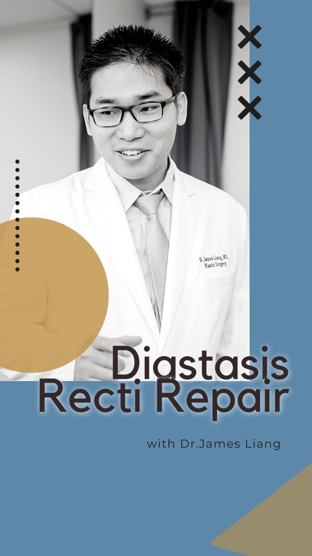 Diastasis recti is a physical complication that usually happens after pregnancy, affecting more than half of women. This condition happens as a result of the separation of the rectus abdominis muscle. The gap that is created can be small or can extend along the whole midline of the abdomen making your belly bulge forward.⁠
⁠
Diastasis recti repair surgery is the best method to treat split tummy muscles. It’s usually done during abdominoplasty surgery (AKA tummy tuck) which aims to tighten and rejuvenate the belly, restoring the pre-pregnancy physique and improving symptoms. ⁠
⁠
Are you interested in correcting your diastasis or undergoing a tummy tuck? Click the link in our bio or call us at 310-784-0644 to schedule your consultation today!⁠
⁠
#diastasis #diastasisrecti #abdominoplasty #tummytuck #abdominalsurgery #pregnancy #postpartum #plasticsurgery #plasticsurgeon #losangelesplasticsurgery #losangelesplasticsurgeon #southbayplasticsurgeons #sbps #southbay