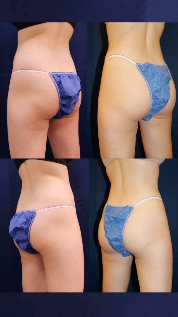 This 25-year old patient wanted to improve the appearance of her butt. She consulted with one of our board-certified plastic surgeons and had liposuction of her abdomen , flanks, and thighs with fat grafting to her butt (AKA a Brazilian butt lift). This took several inches off her waistline and really accentuated her shape. This patient is thrilled with her result!

All photos posted with patient permission.

Click the link in our bio or call us at 310-784-0644 to schedule your consultation today!

#southbayplasticsurgeons #bodytransformation #liposuction #fattransfer #BBL #waistline #diet #exercise #weightloss #sbps #southbay #losangelesplasticsurgery #losangelesplasticsurgeon #plasticsurgery #plasticsurgeon #brazilianbuttlift #fatgrafting