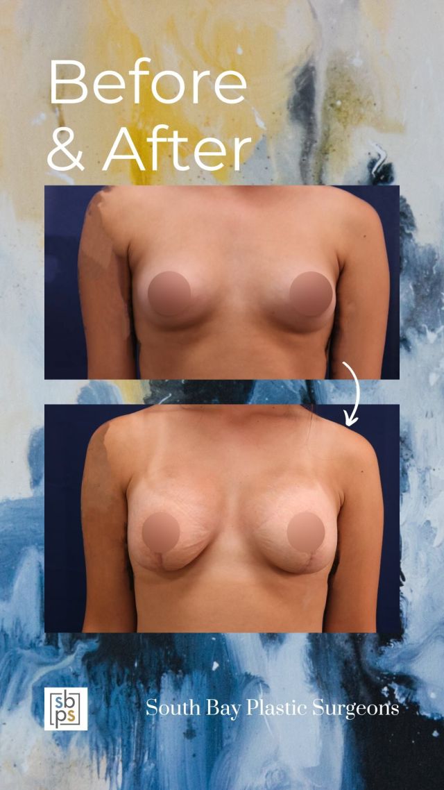 This 27-year-old woman wanted to lift and improve the shape of her breasts. After consulting with one of our board-certified plastic surgeons, she had a breast augmentation and bilateral mastopexy with @idealimplant 300cc high profile implants.  The implants were placed under the muscle through an anchor incision. 

The Ideal implant is a structured saline implant with the feel of silicone and safety profile of saline.

Tattoos removed for patient privacy. Unedited photos at the link in bio. All photos posted with patient permission.

Click the link in our bio or call us at 310-784-0644 to schedule a consultation!

#naturalresults #freethenipple #idealimplant #salineeimplants #breastimplants #breastenhancement #breastaugmentation #mastopexy #breastlift #cosmeticsurgery #plasticsurgery #losangelesplasticsurgeon #southbay #southbayplasticsurgeons #beforeandafter
