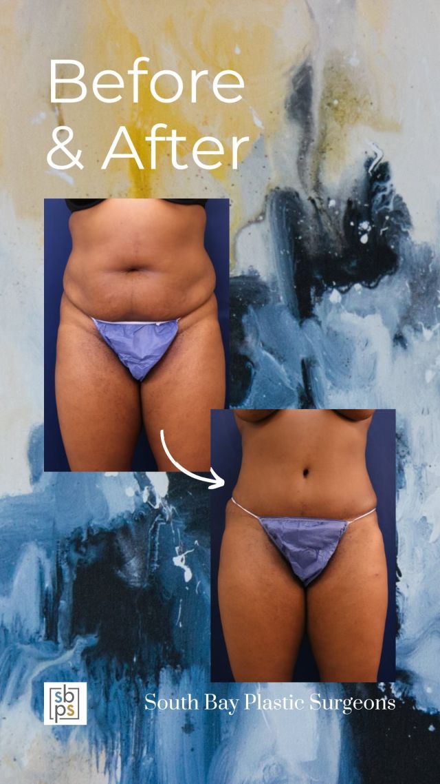 This 44-year old patient wanted to improve the appearance of her waist and butt. She consulted with one of our board-certified plastic surgeons and had circumferential trunk liposuction to accentuate her shape, a Brazilian butt lift, and an abdominoplasty (AKA tummy tuck). These procedures took several inches off her waistline and changed she shape of her body. This patient is thrilled with her result!⁠
⁠
All photos are posted with patient permission.⁠
⁠
Click the link in our bio or call us at 310-784-0644 to schedule your consultation today!⁠
⁠
#southbayplasticsurgeons #sbps #tummytuck #abdominoplasty #bodytransformation #liposuction #fattransfer #BBL #waistline #diet #exercise #weightloss #mommymakeover #southbay #losangelesplasticsurgery #losangelesplasticsurgeon #plasticsurgery #plasticsurgeon #beforeandafter