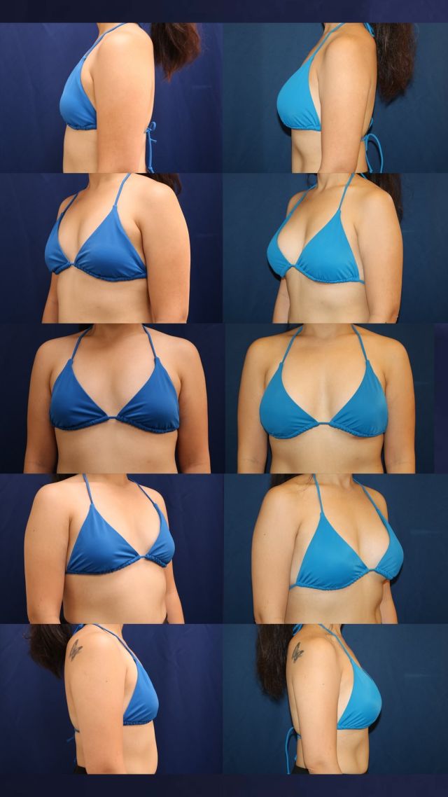 This 28-year-old woman wanted a fuller and more round breast shape. After consulting with one of our board certified plastic surgeons, she had a breast augmentation and bilateral mastopexy with @sientrainc 350cc high profile silicone implants placed under the muscle and through the inframammary (IMG/under the breast) incision.⁠
⁠
This patient loves how she looks in a bikini!⁠
⁠
Unedited photos at the link in bio. All photos posted with patient permission.⁠
⁠
Click the link in our bio or call us at 310-784-0644 to schedule a consultation today!⁠
⁠
#naturalresults #freethenipple #siliconeimplants #breastimplants #breastenhancement #breastaugmentation #cosmeticsurgery #plasticsurgery #losangelesplasticsurgeon #southbay #southbayplasticsurgeons #sientra #sientraimplants #beforeandafter⁠
⁠