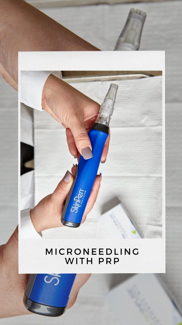 MICRONEEDLING WITH PRP⁠
⁠
Microneedling is truly the fountain of youth! With age, natural collagen production begins to slow and cell structures weaken. Microneedling uses a pen-shaped device that pierces the skin producing collagen and elastin. This treatment can rejuvenate skin, minimize fine lines and wrinkles, reduce the appearance of pores, and improve skin texture and tone. Results from microneedling can be further improved when used in combination with Platelet-Rich Plasma (PRP). PRP treatment involves using the patient’s own blood as a resource to isolate the platelets with a centrifuge. PRP contains proteins and several growth factors leading to more rapid collagen production. Microneedling is FDA-approved and essential to the development of fresh, new skin!⁠
⁠
Click the link in bio or call us at 310-784-0670 to schedule a treatment today!⁠
⁠
@skinpen⁠
⁠
#microneedling #skinpen #spaatsouthbayplasticsurgeons #southbayplasticsurgeons #sbps #medspa #southbay #aging #skin #skincare