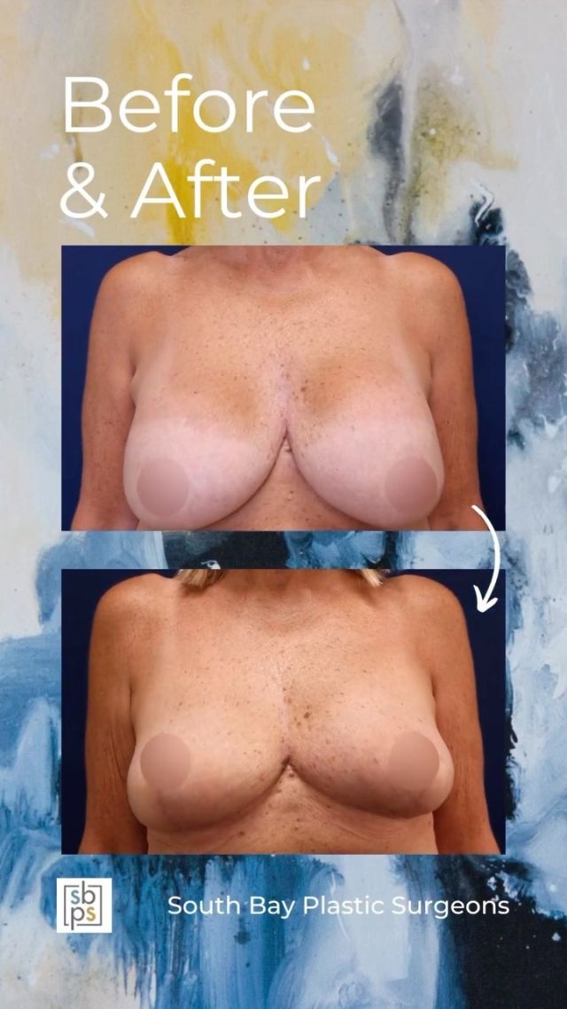 This 62-year old patient had two previous breast augmentations with another surgeon in 2001 and 2018. She was unhappy with the size and placement of her breast implants. Our board-certified plastic surgeon performed an implant removal and bilateral mastopexy to reduce the size of her breasts and give her a perkier result. ⁠
⁠
Unedited photos at the link in bio. All photos posted with patient permission.⁠
⁠
Click the link in our bio or call us at 310-784-0644 to schedule a consultation today!⁠

⁠
#breastaugmentation #braestsurgery #breastrevision #southbayplasticsurgeons #sbps