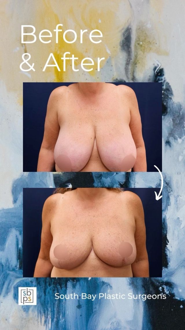 After being diagnosed with breast cancer, this 52-year old patient met with one of our board-certified plastic surgeons about reconstruction surgery. After undergoing a lumpectomy to remove the cancer and obtain clean margins, we performed an oncoplastic reduction.⁠
⁠
This patient is thrilled with her results!⁠
⁠
Unedited photos linked in bio. All photos posted with patient permission.⁠
⁠
Call us at 310-784-0644 to schedule a consultation!⁠
⁠
#breastreduction #southbayplasticsurgeons #sbps #southbay