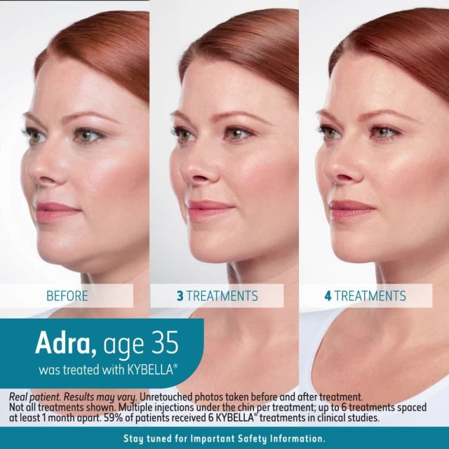 Say goodbye to your double chin with Kybella!⁠
⁠
As one of the most innovative treatments available, Kybella is an FDA-approved cosmetic injectable designed to reduce excess fat on the chin. Comprised of deoxycholic acid, a substance that naturally occurs in the body, Kybella works to break down fat cells which can then be removed through normal metabolic processes. The fat cells are destroyed gradually, producing a noticeably slimmer and more contoured effect on the treated area.⁠
⁠
The benefits of Kybella include:⁠
-Brief treatment time⁠
-No surgery or incisions⁠
-Minimal downtime⁠
-Long-lasting results⁠
-Gradual, natural-looking fat reduction⁠
⁠
Are you interested in Kybella? Click the link in bio or call us at 310-784-0670 to schedule today!⁠
⁠
#southbayplasticsurgeons #sbps #kybella