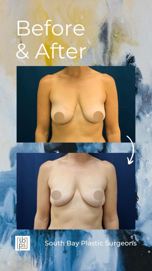 This 46-year old patient was unhappy with the volume loss and sagging she experienced after three pregnancies. @drnewmanplasticsurgery performed a breast lift using an anchor incision as well as a small reduction on the right side for symmetry. He was able to improve the shape and projection of her breasts giving them a more youthful appearance. ⁠
⁠
This patient loves her result! ⁠
⁠
Unedited photos at the link in bio. All photos posted with patient permission.⁠
⁠
Contact us at 310-784-0644 to schedule a consultation today!⁠
⁠
#southbayplasticsurgeons #sbps #breastlift⁠