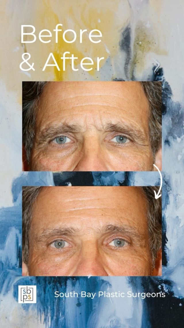This 69-year old patient wanted to improve the placement of his brows. @drliangplasticsurgeon performed a brow lift which improved the appearance of his brows as well as rejuvenated the area around the eyes. ⁠
⁠
This patient looks natural, rested and is thrilled with his result! All photos posted with patient permission.⁠
⁠
Are you interested in facial rejuvenation? Contact us at 310-784-0644 to schedule your consultation today!⁠
⁠
#southbayplasticsurgeons #sbps #browlift⁠