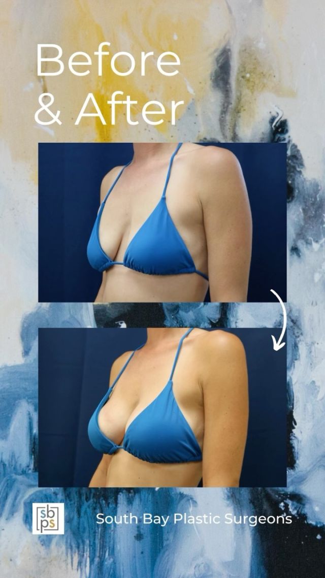 This 40-year-old woman wanted a fuller and more round breast shape. @drnewmanplasticsurgery performed a breast augmentation with @sientrainc 350cc high profile silicone implants placed in the dual plane and through the inframammary (IMF/under the breast) incision. ⁠
⁠
This patient loves how she looks in a bikini!⁠
⁠
Unedited photos at the link in bio. All photos posted with patient permission.⁠
⁠
Click the link in our bio or call us at 310-784-0644 to schedule a consultation today!⁠
⁠
#southbayplasticsurgeons #sbps #breastaugmentation⁠
⁠