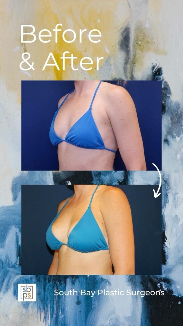 This 36-year-old woman wanted a fuller and more round breast shape. @drnewmanplasticsurgery performed a breast augmentation with high profile saline implants placed under the muscle and through the inframammary (IMF/under the breast) incision. We filled the right implant to 270cc and the left implant to 305cc to correct some asymmetry.⁠
⁠
This patient loves how she looks in a bikini!⁠
⁠
Unedited photos at the link in bio. All photos posted with patient permission.⁠
⁠
Click the link in our bio or call us at 310-784-0644 to schedule a consultation today!⁠
⁠
#southbayplasticsurgeons #sbps #breastaugmentation