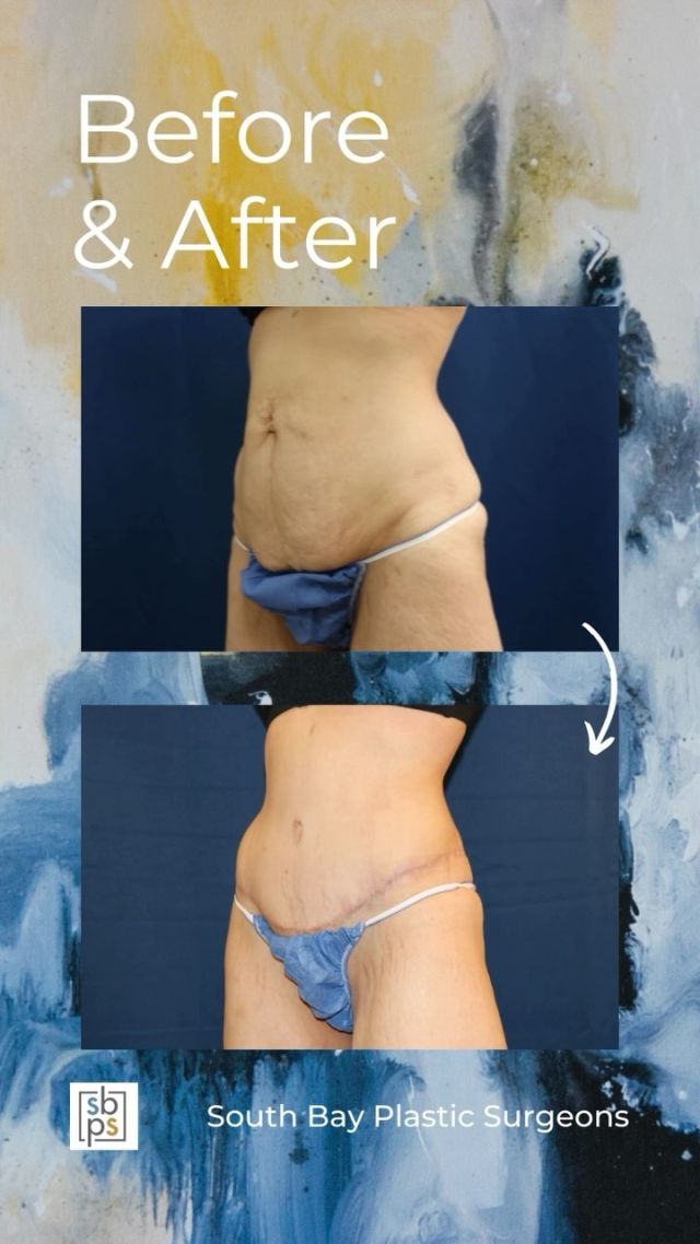 This 31-year old patient wanted to improve the appearance of her abdomen. After having two children, she was unhappy with the laxity in her abdominal muscles and excess skin left behind. She consulted with @drwhitneyburrell, one of our board-certified plastic surgeons, and had an abdominoplasty (AKA tummy tuck) and liposuction to flatten her abdomen and accentuate her shape. This procedure took several inches off her waistline and she is thrilled with her result!⁠
⁠
All photos posted with patient permission.⁠
⁠
Click the link in our bio or call us at 310-784-0644 to schedule your consultation today!⁠
⁠
#southbayplasticsurgeons #tummytuck #abdominoplasty ⁠
⁠