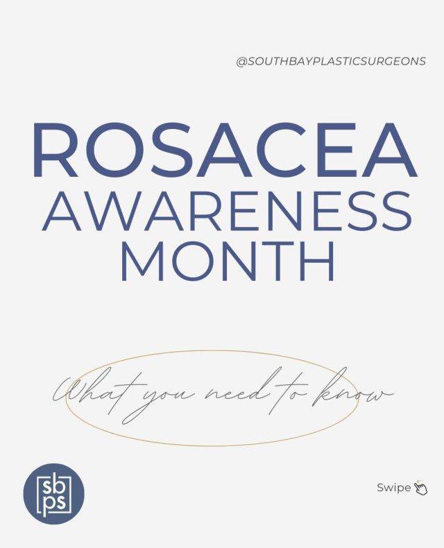April is Rosacea Awareness Month!⁠
⁠
Don't let Rosacea dim your glow! Rosacea is a chronic skin condition that affects more than 16 million Americans. It is estimated that most patients with rosacea are not even aware it is a condition that can be treated!⁠
⁠
Symptoms of Rosacea include:⁠
⁠
-Flushing⁠
-Visible blood vessels⁠
-Bumps and acne spots⁠
-Eye irritation⁠
-Dryness⁠
-Burning⁠
-Stinging⁠
-Swelling⁠
⁠
At The Spa at South Bay Plastic Surgeons, we specialize in creating treatment plans and product recommendations to address all types of skin concerns. Click the link in bio or call us at 310-784-0670 to schedule today!⁠
⁠
#southbayplasticsurgeons #sbps #rosaeaawarenessmonth