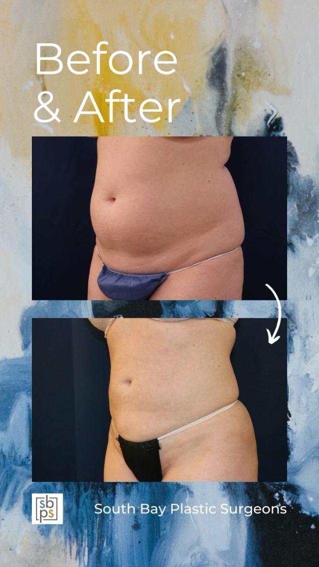 This 47-year old patient wanted to improve the appearance of her abdomen. @drnewmanplasticsurgery performed liposuction of her abdomen and back taking several inches off her waistline. This procedure changed the shape of her body and this patient is thrilled with her result!⁠
⁠
All photos posted with patient permission.⁠
⁠
Click the link in our bio or call us at 310-784-0644 to schedule your consultation today!⁠
⁠
#southbayplasticsurgeons #sbps #liposuction⁠